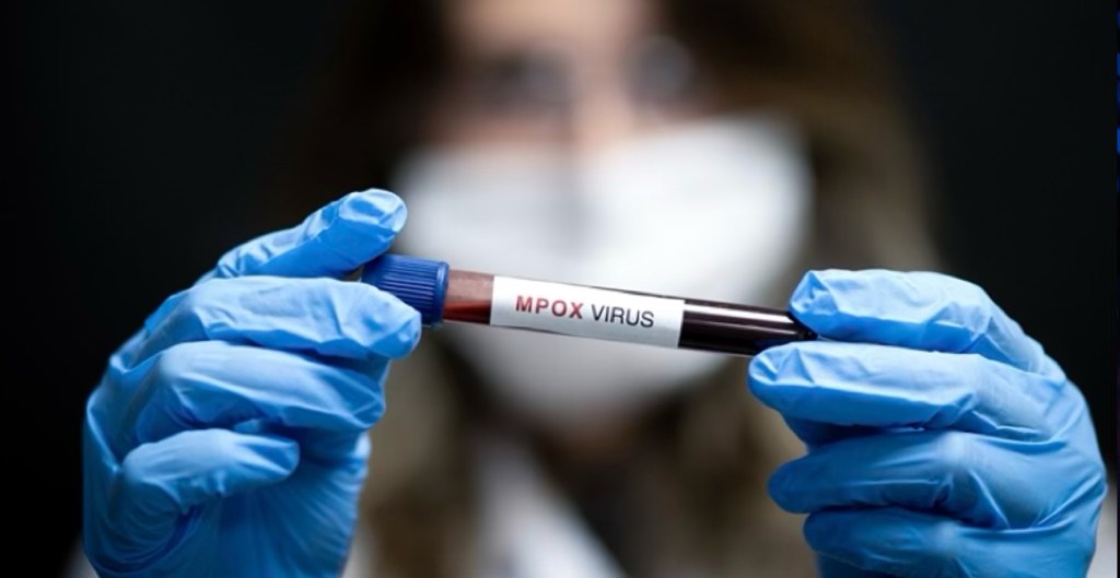 Global Mpox Outbreak Sparks Health Concerns: What You Need to&nbsp;Know